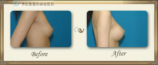 广州隆胸会留疤吗 假体隆胸术切口在哪里-整形-广州后勤医院医学整形美容中心