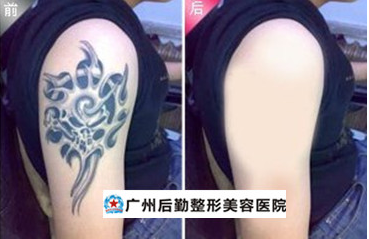 纹身让我找不到工作怎么办 广州激光洗纹身-整