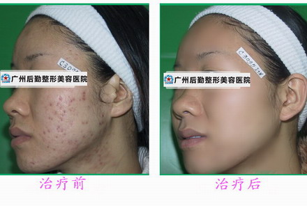 像束激光可以去痘坑吗 广州祛痘坑什么方法好