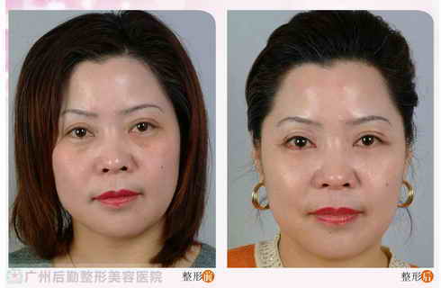 怎么去眼袋效果好些 236d8eee-02db-468f-a16b-e187a004f2b8.jpg