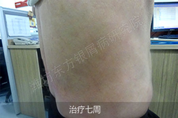 银屑病治疗医院排名_治疗银屑病的药膏图片(2)