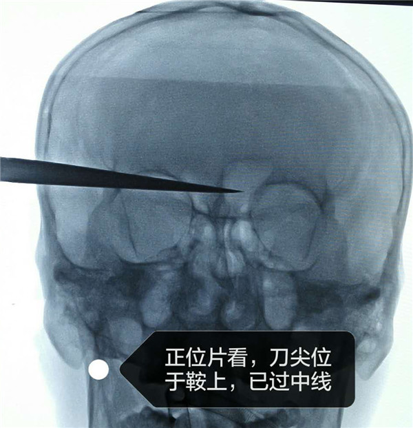 潍坊市人民医院脑科分院神经外二科收治一名重