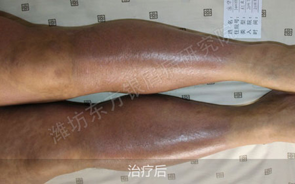 银屑病治疗医院排名_治疗银屑病的药膏图片